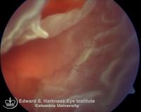 Rhegmatogenous retinal detachment demonstrating a flap tear with one bridging vessel and a posteriorly rolled edge. The irregular retinal folds are caused by mild proliferative vitreoretinopathy (PVR).
